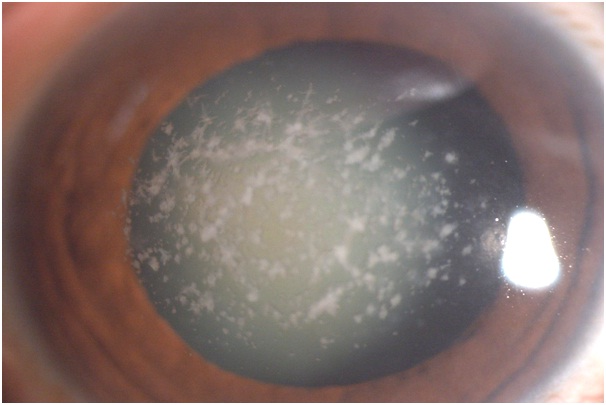 Corneal Dystrophy Treatment for Clearer Vision cornea-eye-treatment-corneal-dystrophy