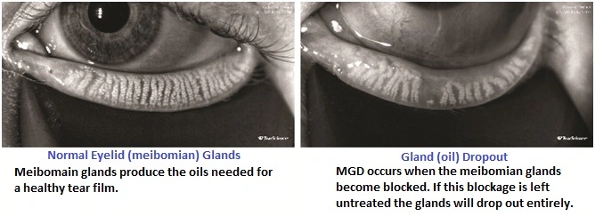 Cornea Treatment for Dry Eye Syndrome cornea-eye-treatment-dry-eye-syndrome