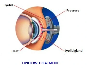 cornea-eye-treatment-lipiflow-treatment