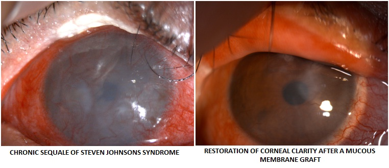 Corneal Clarity Restoration for Ocular Surface Disorders cornea-eye-treatment-ocular-surface-disorders-corneal-clarity