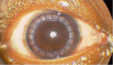 cornea-eye-treatment-penetrating-keratoplasty