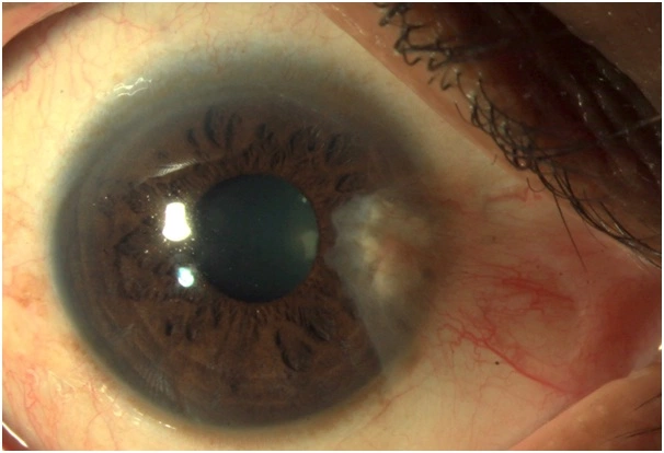 Pterygium Eye Treatment for Healthy Cornea cornea-eye-treatment-pterygium