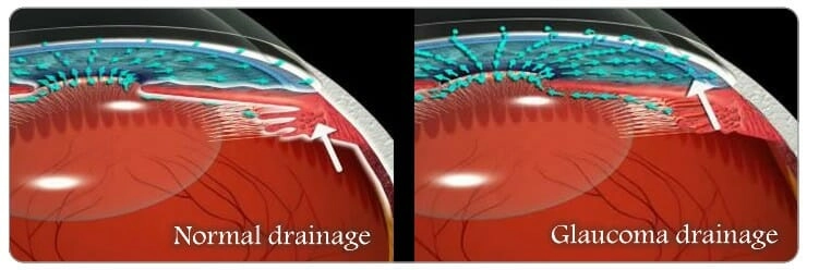 glaucoma-treatment-normal-vs-glaucoma-eye-fluid-drainage