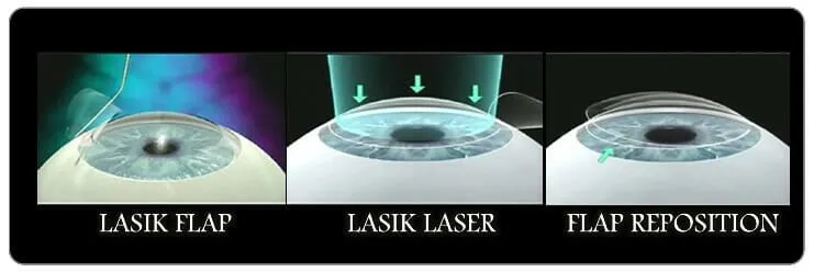 lasik-eye-surgery-procedures