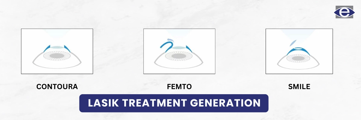 lasik-treatment-generation