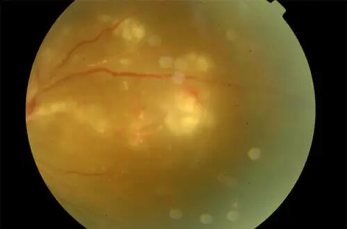 uvea-ocular-inflammation--is-uveitis-is-curable-2