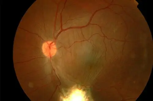uvea-ocular-inflammation-is-uveitis-is-curable-1